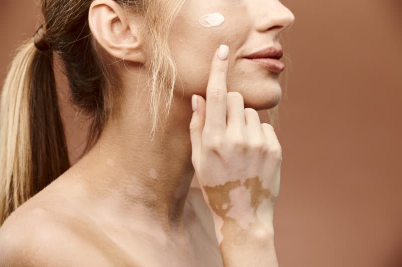 White woman with vitiligo putting cream on her face