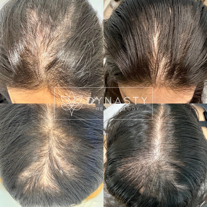 Before and after photos of Alma TED treatment for hair loss