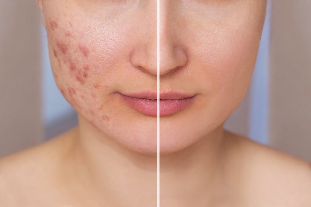 Before and after accutane treatment showing clearing skin