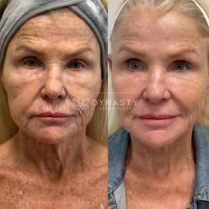 UltraClear-Perioral-Coring-2-photos